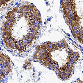 PMFBP1 was detected in immersion fixed paraffin-embedded sections of human cervical cancer tissue using Rabbit Anti-Human PMFBP1 Monoclonal Antibody (Catalog # MAB9967) at 3 µg/mL for 1 hour at room temperature followed by incubation with the Anti-Rabbit IgG VisUCyte™ HRP Polymer Antibody (Catalog # VC003). Tissue was stained using DAB (brown) and counterstained with hematoxylin (blue). Specific staining was localized to cytoplasm in sperm cells. View our protocol for IHC Staining with VisUCyte HRP Polymer Detection Reagents.