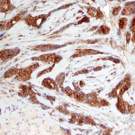 PRAS40 was detected in immersion fixed paraffin-embedded sections of human breast using Sheep Anti-Human PRAS40 Antigen Affinity-purified Polyclonal Antibody (Catalog # AF6408) at 3 µg/mL overnight at 4 °C. Before incubation with the primary antibody, tissue was subjected to heat-induced epitope retrieval using Antigen Retrieval Reagent-Basic (Catalog # CTS013). Tissue was stained using the Anti-Sheep HRP-DAB Cell & Tissue Staining Kit (brown; Catalog # CTS019) and counterstained with hematoxylin (blue). Specific staining was localized to epithelial cells. View our protocol for Chromogenic IHC Staining of Paraffin-embedded Tissue Sections.