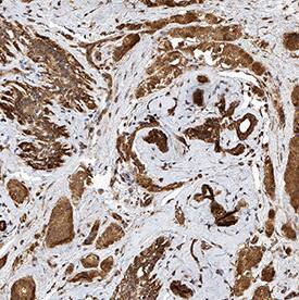 PTGER1 was detected in immersion fixed paraffin-embedded sections of human breast cancer tissue using Mouse Anti-Human PTGER1 Monoclonal Antibody (Catalog # MAB100081) at 5 µg/mL for 1 hour at room temperature followed by incubation with the Anti-Mouse IgG VisUCyte™ HRP Polymer Antibody (Catalog # VC001). Before incubation with the primary antibody, tissue was subjected to heat-induced epitope retrieval using Antigen Retrieval Reagent-Basic (Catalog # CTS013). Tissue was stained using DAB (brown) and counterstained with hematoxylin (blue). Specific staining was localized to cytoplasm. View our protocol for IHC Staining with VisUCyte HRP Polymer Detection Reagents.