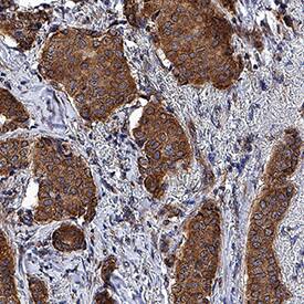 PTGER1 was detected in immersion fixed paraffin-embedded sections of human breast cancer tissue using Mouse Anti-Human PTGER1 Monoclonal Antibody (Catalog # MAB10008) at 5 µg/mL for 1 hour at room temperature followed by incubation with the Anti-Mouse IgG VisUCyte™ HRP Polymer Antibody (Catalog # VC001). Before incubation with the primary antibody, tissue was subjected to heat-induced epitope retrieval using Antigen Retrieval Reagent-Basic (Catalog # CTS013). Tissue was stained using DAB (brown) and counterstained with hematoxylin (blue). Specific staining was localized to cytoplasm and cell surfaces. View our protocol for IHC Staining with VisUCyte HRP Polymer Detection Reagents.