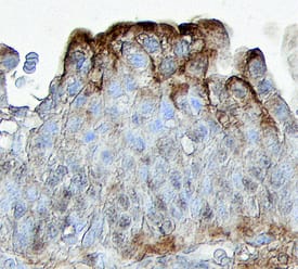 PTGER2 was detected in immersion fixed paraffin-embedded sections of human bladder using Human PTGER2 Monoclonal Antibody (Catalog # MAB6656) at 25 µg/mL overnight at 4 °C. Tissue was stained using the Anti-Mouse HRP-DAB Cell & Tissue Staining Kit (brown; Catalog # CTS002) and counterstained with hematoxylin (blue). Strongest staining was localized to umbrella cells. View our protocol for Chromogenic IHC Staining of Paraffin-embedded Tissue Sections.