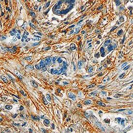 Periostin/OSF-2 was detected in immersion fixed paraffin-embedded sections of human breast using Goat Anti-Human Periostin/OSF-2 Antigen Affinity-purified Polyclonal Antibody (Catalog # AF3548) at 10 µg/mL overnight at 4 °C. Tissue was stained using the Anti-Goat HRP-DAB Cell & Tissue Staining Kit (brown; CTS008) and counterstained with hematoxylin (blue). Specific staining was localized to stromal cells. View our protocol for Chromogenic IHC Staining of Paraffin-embedded Tissue Sections.