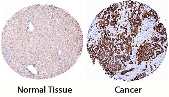 Peroxiredoxin 4 was detected in immersion fixed paraffin-embedded sections of human liver cancer tissue using Goat Anti-Human/Mouse/Rat Peroxiredoxin 4 Antigen Affinity-purified Polyclonal Antibody (Catalog # AF5460) at 0.3 µg/mL for 1 hour at room temperature followed by incubation with the Anti-Goat IgG VisUCyte™ HRP Polymer Antibody (Catalog # VC004). Tissue was stained using DAB (brown) and counterstained with hematoxylin (blue). Specific staining was localized to cancer cells. View our protocol for IHC Staining with VisUCyte HRP Polymer Detection Reagents.
