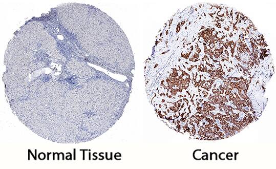Peroxiredoxin 4 was detected in immersion fixed paraffin-embedded sections of human liver cancer tissue using Mouse Anti-Human Peroxiredoxin 4 Monoclonal Antibody (Catalog # MAB5460) at 5 µg/mL for 1 hour at room temperature followed by incubation with the Anti-Mouse IgG VisUCyte™ HRP Polymer Antibody (Catalog # VC001). Tissue was stained using DAB (brown) and counterstained with hematoxylin (blue). Specific staining was localized to cancer cells. View our protocol for IHC Staining with VisUCyte HRP Polymer Detection Reagents.