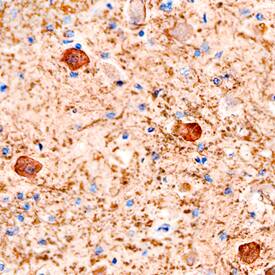 Plexin B1 was detected in immersion fixed paraffin-embedded sections of human brain using Mouse Anti-Human Plexin B1 Monoclonal Antibody (Catalog # MAB3749) at 15 µg/mL overnight at 4 °C. Before incubation with the primary antibody, tissue was subjected to heat-induced epitope retrieval using Antigen Retrieval Reagent-Basic (Catalog # CTS013). Tissue was stained using the Anti-Mouse HRP-DAB Cell & Tissue Staining Kit (brown; Catalog # CTS002) and counterstained with hematoxylin (blue). Specific staining was localized to neuronal cell bodies. View our protocol for Chromogenic IHC Staining of Paraffin-embedded Tissue Sections.