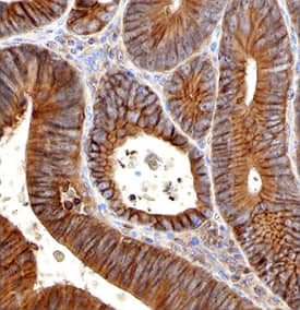 Plexin B2 was detected in immersion fixed paraffin-embedded sections of human colon cancer using 3 µg/mL Sheep Anti-Human Plexin B2 Antigen Affinity-purified Polyclonal Antibody (Catalog # AF5329) overnight at 4 °C. Before incubation with the primary antibody tissue was subjected to heat-induced epitope retrieval using Antigen Retrieval Reagent-Basic (Catalog # CTS013). Tissue was stained with the Anti-Sheep HRP-DAB Cell & Tissue Staining Kit (brown; Catalog # CTS019) and counterstained with hematoxylin (blue). Specific labeling was localized to the plasma membrane and cytoplasm of epithelial cells. View our protocol for Chromogenic IHC Staining of Paraffin-embedded Tissue Sections.