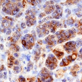 Plexin D1 was detected in immersion fixed paraffin-embedded sections of human melanoma using Goat Anti-Human Plexin D1 Antigen Affinity-purified Polyclonal Antibody (Catalog # AF4160) at 3 µg/mL overnight at 4 °C. Before incubation with the primary antibody, tissue was subjected to heat-induced epitope retrieval using Antigen Retrieval Reagent-Basic (Catalog # CTS013). Tissue was stained using the Anti-Goat HRP-DAB Cell & Tissue Staining Kit (brown; Catalog # CTS008) and counterstained with hematoxylin (blue). Specific staining was localized to plasma membranes. View our protocol for Chromogenic IHC Staining of Paraffin-embedded Tissue Sections.