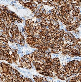 Procalcitonin was detected in immersion fixed paraffin-embedded sections of human thyroid using Mouse Anti-Human Procalcitonin Monoclonal Antibody (Catalog # MAB8350) at 5 µg/mL for 1 hour at room temperature followed by incubation with the Anti-Mouse IgG VisUCyte™ HRP Polymer Antibody (Catalog # VC001). Before incubation with the primary antibody, tissue was subjected to heat-induced epitope retrieval using Antigen Retrieval Reagent-Basic (Catalog # CTS013). Tissue was stained using DAB (brown) and counterstained with hematoxylin (blue). Specific staining was localized to cytoplasm and cell membranes. View our protocol for IHC Staining with VisUCyte HRP Polymer Detection Reagents.