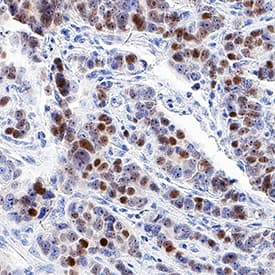 Progesterone R B/NR3C3 was detected in immersion fixed paraffin-embedded sections of human prostate cancer tissue using Mouse Anti-Human Progesterone R B/NR3C3 Monoclonal Antibody (Catalog # MAB5886) at 5 µg/mL for 1 hour at room temperature followed by incubation with the Anti-Mouse IgG VisUCyte™ HRP Polymer Antibody (Catalog # VC001). Tissue was stained using DAB (brown) and counterstained with hematoxylin (blue). Specific staining was localized to nuclei. View our protocol for IHC Staining with VisUCyte HRP Polymer Detection Reagents.