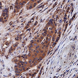 Progranulin/PGRN was detected in immersion fixed paraffin-embedded sections of human breast cancer tissue using Mouse Anti-Human Progranulin/PGRN Polyclonal Antibody (Catalog # MAB24201) at 5 µg/mL for 1 hour at room temperature followed by incubation with the Anti-Mouse IgG VisUCyte™ HRP Polymer Antibody (Catalog # VC001). Tissue was stained using DAB (brown) and counterstained with hematoxylin (blue). Specific staining was localized to cytoplasm in cancer cells. View our protocol for IHC Staining with VisUCyte HRP Polymer Detection Reagents.