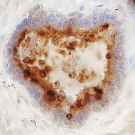 Prostatic Acid Phosphatase/ACPP was detected in immersion fixed paraffin-embedded sections of human prostate using Human Prostatic Acid Phosphatase/ACPP Monoclonal Antibody (Catalog # MAB6240) at 15 µg/mL overnight at 4 °C. Before incubation with the primary antibody, tissue was subjected to heat-induced epitope retrieval using Antigen Retrieval Reagent-Basic (Catalog # CTS013). Tissue was stained using the Anti-Mouse HRP-DAB Cell & Tissue Staining Kit (brown; Catalog # CTS002) and counterstained with hemotoxylin (blue). Specific staining was localized to the cytoplasm of epithelial cells. View our protocol for Chromogenic IHC Staining of Paraffin-embedded Tissue Sections.