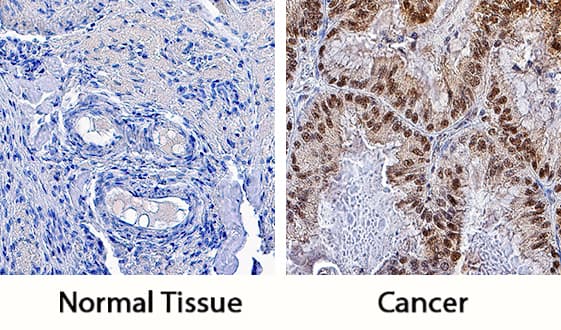 Pygopus-2 was detected in immersion fixed paraffin-embedded sections of normal human ovary (left panel) and ovarian cancer tissue (right panel) using Goat Anti-Human Pygopus-2 Antigen Affinity-purified Polyclonal Antibody (Catalog # AF3616) at 3 µg/mL overnight at 4 °C. Tissue was stained using the Anti-Goat HRP-DAB Cell & Tissue Staining Kit (brown; Catalog # CTS008) and counterstained with hematoxylin (blue). Specific staining was localized to nuclei. View our protocol for Chromogenic IHC Staining of Paraffin-embedded Tissue Sections.