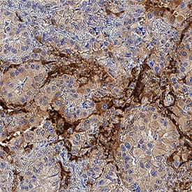 RAGE was detected in immersion fixed paraffin-embedded sections of human liver cancer tissue using Mouse Anti-Human RAGE Monoclonal Antibody (Catalog # MAB1145) at 0.5 µg/mL for 1 hour at room temperature followed by incubation with the Anti-Mouse IgG VisUCyte™ HRP Polymer Antibody (Catalog # VC001). Tissue was stained using DAB (brown) and counterstained with hematoxylin (blue). Specific staining was localized to cell nuclei. View our protocol for IHC Staining with VisUCyte HRP Polymer Detection Reagents.