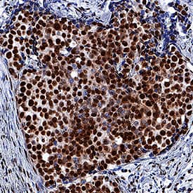 Retinoblastoma Binding Protein 4 (RBBP4) was detected in immersion fixed paraffin-embedded sections of human breast cancer tissue using Mouse Anti-Human/Mouse/Rat RBBP4 Monoclonal Antibody (Catalog # MAB7416) at 5 µg/mL for 1 hour at room temperature followed by incubation with the Anti-Mouse IgG VisUCyte™ HRP Polymer Antibody (Catalog # VC001). Tissue was stained using DAB (brown) and counterstained with hematoxylin (blue). Specific staining was localized to nuclei. View our protocol for IHC Staining with VisUCyte HRP Polymer Detection Reagents.