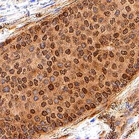 Rad51 was detected in immersion fixed paraffin-embedded sections of human breast cancer tissue using Mouse Anti-Human Rad51 Monoclonal Antibody (Catalog # MAB9948) at 5 µg/mL for 1 hour at room temperature followed by incubation with the Anti-Mouse IgG VisUCyte™ HRP Polymer Antibody (Catalog # VC001). Tissue was stained using DAB (brown) and counterstained with hematoxylin (blue). Specific staining was localized to nuclei. View our protocol for IHC Staining with VisUCyte HRP Polymer Detection Reagents.
