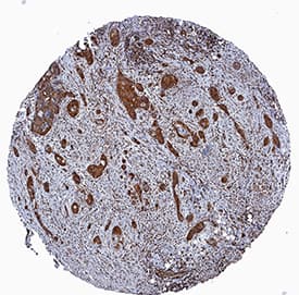 RelA/NF kappa B p65 was detected in immersion fixed paraffin-embedded sections of human squamous cell carcinoma using Sheep Anti-Human/Mouse/Rat RelA/NF kappa B p65 Antigen Affinity-purified Polyclonal Antibody (Catalog # AF5078) at 3 µg/mL overnight at 4 °C. Tissue was stained using the Anti-Sheep HRP-DAB Cell & Tissue Staining Kit (brown; Catalog # CTS019) and counterstained with hematoxylin (blue). Specific staining was localized to cytoplasm in cancer cells. View our protocol for Chromogenic IHC Staining of Paraffin-embedded Tissue Sections.