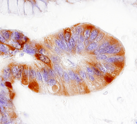 Ribosomal Protein S6 was detected in immersion fixed paraffin-embedded sections of human colon cancer tissue using 5 µg/mL Rabbit Anti-Human/Mouse/Rat Phospho-Ribosomal Protein S6 (S235/S236) Antigen Affinity-purified Polyclonal Antibody (Catalog # AF3918) overnight at 4 °C. Tissue was stained with the Anti-Rabbit HRP-DAB Cell & Tissue Staining Kit (brown; Catalog # CTS005) and counterstained with hematoxylin (blue). Specific labeling was localized to vascular endothelial cell within glomeruli. View our protocol for Chromogenic IHC Staining of Paraffin-embedded Tissue Sections.