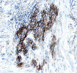 S100A10 was detected in immersion fixed paraffin-embedded sections of human kidney cancer tissue using 5 &micro;g/mL Goat Anti-Human S100A10 Antigen Affinity-purified Polyclonal Antibody (Catalog # AF1698) overnight at 4 &deg;C. Tissue was stained with the Anti-Goat HRP-DAB Cell & Tissue Staining Kit (brown; Catalog # CTS008) and counterstained with hematoxylin (blue). View our protocol for Chromogenic IHC Staining of Paraffin-embedded Tissue Sections.