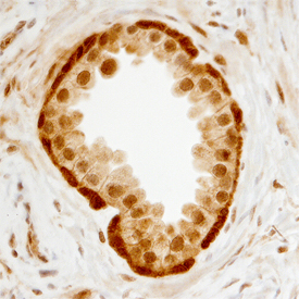 S100A2 was detected in immersion fixed paraffin-embedded sections of human prostate using Mouse Anti-Human S100A2 Monoclonal Antibody (Catalog # MAB48701) at 15 µg/mL overnight at 4 °C. Before incubation with the primary antibody, tissue was subjected to heat-induced epitope retrieval using Antigen Retrieval Reagent-Basic (Catalog # CTS013). Tissue was stained using the Anti-Mouse HRP-DAB Cell & Tissue Staining Kit (brown; Catalog # CTS002) and counterstained with hematoxylin (blue). Specific staining was localized to nuclei in epithelial, smooth muscle and stromal cells. View our protocol for Chromogenic IHC Staining of Paraffin-embedded Tissue Sections.