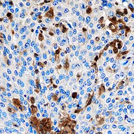 S100A4 was detected in immersion fixed paraffin-embedded sections of human cervical cancer tissue using Mouse Anti-Human S100A4 Monoclonal Antibody (Catalog # MAB4137) at 15 µg/mL overnight at 4 °C. Tissue was stained using the Anti-Mouse HRP-DAB Cell & Tissue Staining Kit (brown; Catalog # CTS002) and counterstained with hematoxylin (blue). Specific staining was localized to cytoplasm in cancer cells. View our protocol for Chromogenic IHC Staining of Paraffin-embedded Tissue Sections.