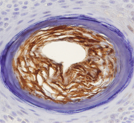 S100A7 was detected in immersion fixed paraffin-embedded sections of human skin (hair follicle) using Mouse Anti-Human S100A7 Monoclonal Antibody (Catalog # MAB4475) at 15 µg/mL overnight at 4 °C. Before incubation with the primary antibody, tissue was subjected to heat-induced epitope retrieval using Antigen Retrieval Reagent-Basic (Catalog # CTS013). Tissue was stained using the Anti-Mouse HRP-DAB Cell & Tissue Staining Kit (brown; Catalog # CTS002) and counterstained with hematoxylin (blue). Specific staining was localized to hair follicle. View our protocol for Chromogenic IHC Staining of Paraffin-embedded Tissue Sections.