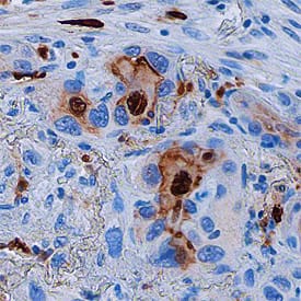S100A8 was detected in immersion fixed paraffin-embedded sections of human lung cancer tissue using Mouse Anti-Human S100A8 Monoclonal Antibody (Catalog # MAB4570) at 15 µg/mL overnight at 4 °C. Before incubation with the primary antibody, tissue was subjected to heat-induced epitope retrieval using Antigen Retrieval Reagent-Basic (Catalog # CTS013). Tissue was stained using the Anti-Mouse HRP-DAB Cell & Tissue Staining Kit (brown; Catalog # CTS002) and counterstained with hematoxylin (blue). Specific staining was localized to nuclei and cytoplasm of cancer cells. View our protocol for Chromogenic IHC Staining of Paraffin-embedded Tissue Sections.