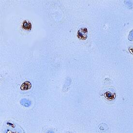 S100A9 was detected in immersion fixed paraffin-embedded sections of human cartilage using Sheep Anti-Human S100A9 Antigen Affinity-purified Polyclonal Antibody (Catalog # AF5578) at 1 µg/mL overnight at 4 °C. Tissue was stained using the Anti-Sheep HRP-DAB Cell & Tissue Staining Kit (brown; Catalog # CTS019) and counterstained with hematoxylin (blue). Specific staining was localized to cytoplasm of chondrocytes. View our protocol for Chromogenic IHC Staining of Paraffin-embedded Tissue Sections.