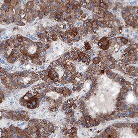 SHBG was detected in immersion fixed paraffin-embedded sections of human hepatocellular carcinoma tissue using Mouse Anti-Human SHBG Monoclonal Antibody (Catalog # MAB26563) at 5 µg/mL for 1 hour at room temperature followed by incubation with the Anti-Mouse IgG VisUCyte™ HRP Polymer Antibody (Catalog # VC001). Before incubation with the primary antibody, tissue was subjected to heat-induced epitope retrieval using Antigen Retrieval Reagent-Basic (Catalog # CTS013). Tissue was stained using DAB (brown) and counterstained with hematoxylin (blue). Specific staining was localized to cytoplasm in cancer cells. View our protocol for IHC Staining with VisUCyte HRP Polymer Detection Reagents.