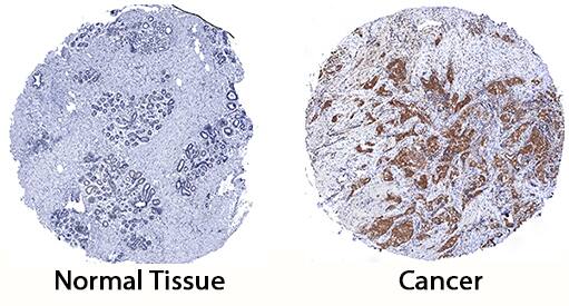 SHIP2 was detected in immersion fixed paraffin-embedded sections of human breast cancer tissue using Sheep Anti-Human/Mouse/Rat SHIP2 Antigen Affinity-purified Polyclonal Antibody (Catalog # AF5389) at 3 µg/mL for 1 hour at room temperature followed by incubation with the Anti-Goat IgG VisUCyte™ HRP Polymer Antibody (Catalog # VC004). Tissue was stained using DAB (brown) and counterstained with hematoxylin (blue). Specific staining was localized to cytoplasm in cancer cells. View our protocol for IHC Staining with VisUCyte HRP Polymer Detection Reagents.