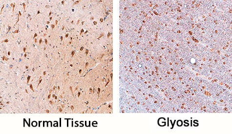 SOX11 was detected in immersion fixed paraffin-embedded sections of human brain (hippocampus) using Sheep Anti-Human SOX11 Antigen Affinity-purified Polyclonal Antibody (Catalog # AF3976) at 3 µg/mL overnight at 4 °C. Tissue was stained using the Anti-Sheep HRP-DAB Cell & Tissue Staining Kit (brown; Catalog # CTS020) and counterstained with hematoxylin (blue). Specific staining was localized to neurons. View our protocol for Chromogenic IHC Staining of Paraffin-embedded Tissue Sections.