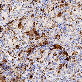 SR-AI/MSR was detected in immersion fixed paraffin-embedded sections of human lung tissue using Goat Anti-Human SR-AI/MSR Antigen Affinity-purified Polyclonal Antibody (Catalog # AF2708) at 1 µg/mL for 1 hour at room temperature followed by incubation with the Anti-Goat IgG VisUCyte™ HRP Polymer Antibody (Catalog # VC004). Tissue was stained using DAB (brown) and counterstained with hematoxylin (blue). Specific staining was localized to macrophages. View our protocol for IHC Staining with VisUCyte HRP Polymer Detection Reagents.