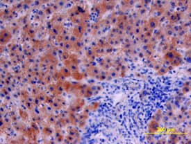 Serpin E1/PAI-1 was detected in immersion fixed paraffin-embedded sections of human liver cancer tissue using Goat Anti-Human Serpin E1/PAI-1 Antigen Affinity-purified Polyclonal Antibody (Catalog # AF1786) at 15 µg/mL overnight at 4 °C. Tissue was stained using the Anti-Goat HRP-DAB Cell & Tissue Staining Kit (brown; Catalog # CTS008) and counterstained with hematoxylin (blue). View our protocol for Chromogenic IHC Staining of Paraffin-embedded Tissue Sections.