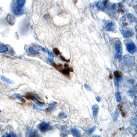Smad2 was detected in immersion fixed paraffin-embedded sections of human pancreatic cancer tissue using Goat Anti-Human Smad2 Antigen Affinity-purified Polyclonal Antibody (Catalog # AF4037) at 5 µg/mL overnight at 4 °C. Tissue was stained using the Anti-Goat HRP-DAB Cell & Tissue Staining Kit (brown; Catalog # CTS008) and counterstained with hematoxylin (blue). Specific staining was localized to nuclei. View our protocol for Chromogenic IHC Staining of Paraffin-embedded Tissue Sections.