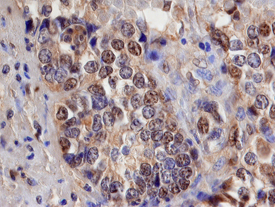 Smad3 was detected in immersion fixed paraffin-embedded sections of human pancreatic cancer tissue using 15 &micro;g/mL Rat Anti-Human Smad3 Monoclonal Antibody (Catalog # MAB4038) overnight at 4 &deg;C. Before incubation with the primary antibody tissue was subjected to heat-induced epitope retrieval using Antigen Retrieval Reagent-Basic (Catalog # CTS013). Tissue was stained with the Anti-Mouse HRP-DAB Cell & Tissue Staining Kit (brown; Catalog # CTS002) and counterstained with hematoxylin (blue). View our protocol for Chromogenic IHC Staining of Paraffin-embedded Tissue Sections.
