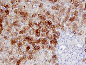 Smad7 was detected in immersion fixed paraffin-embedded sections of human liver cancer tissue using 25 &micro;g/mL Human/Mouse/Rat Smad7 Monoclonal Antibody (Catalog # MAB2029) overnight at 4 &deg;C. Tissue was stained with the Anti-Mouse HRP-DAB Cell & Tissue Staining Kit (brown; Catalog # CTS002) and counterstained with hematoxylin (blue). View our protocol for Chromogenic IHC Staining of Paraffin-embedded Tissue Sections.