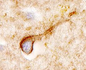 Somatostatin R2/ SSTR2 was detected in immersion fixed paraffin-embedded sections of human brain (cingulate cortex) using 3 µg/mL Human Somatostatin R2/SSTR2 Monoclonal Antibody (Catalog # MAB4224) overnight at 4 °C. Tissue was stained with the Anti-Mouse HRP-DAB Cell & Tissue Staining Kit (brown; Catalog # CTS002) and counterstained with hematoxylin (blue). View our protocol for Chromogenic IHC Staining of Paraffin-embedded Tissue Sections.