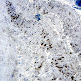 <b>Biological Strategies Validation. </b>Src phosphorylated at Y419 was detected in immersion fixed paraffin-embedded sections of human colon using Rabbit Anti-Human Phospho-Src (Y419) Antigen Affinity-purified Polyclonal Antibody (Catalog # AF2685) at 15 µg/mL overnight at 4 °C. Tissue was stained using the Anti-Rabbit HRP-DAB Cell & Tissue Staining Kit (brown; Catalog # CTS005) and counterstained with hematoxylin (blue). Specific labeling was localized to the cytoplasm of epithelial cells. View our protocol for Chromogenic IHC Staining of Paraffin-embedded Tissue Sections.