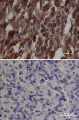Src phosphorylated at Y419 was detected in immersion fixed paraffin-embedded sections of human liver cancer tissue using Rabbit Anti-Human Phospho-Src (Y419) Antigen Affinity-purified Polyclonal Antibody (Catalog # AF2685) at 10 µg/mL overnight at 4 °C. Tissue was stained using the Anti-Rabbit HRP-DAB Cell & Tissue Staining Kit (brown; Catalog # CTS005) and counterstained with hematoxylin (blue). Lower panel shows a lack of labeling if primary antibodies are omitted and tissue is stained only with secondary antibody followed by incubation with detection reagents. View our protocol for Chromogenic IHC Staining of Paraffin-embedded Tissue Sections.