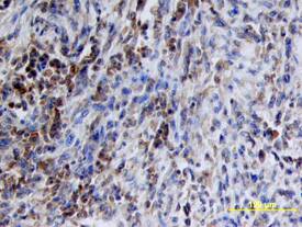 Src was detected in immersion fixed paraffin-embedded sections of human liver cancer tissue using Human/Mouse/Rat Src Antigen Affinity-purified Polyclonal Antibody (Catalog # AF3389) at 15 µg/mL overnight at 4 °C. Tissue was stained using the Anti-Goat HRP-DAB Cell & Tissue Staining Kit (brown; Catalog # CTS008) and counterstained with hematoxylin (blue). View our protocol for Chromogenic IHC Staining of Paraffin-embedded Tissue Sections.