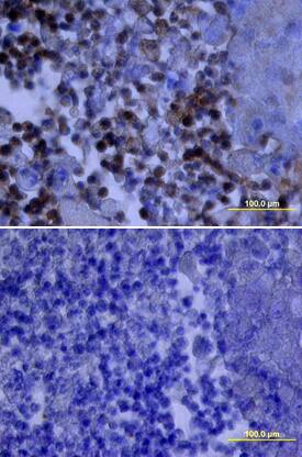 Src was detected in immersion fixed paraffin-embedded sections of human lung cancer tissue using Mouse Anti-Human Src Monoclonal Antibody (Catalog # MAB3807) at 25 µg/mL overnight at 4 °C. Tissue was stained using the Anti-Mouse HRP-DAB Cell & Tissue Staining Kit (brown; Catalog # CTS002) and counterstained with hematoxylin (blue). Lower panel shows a lack of labeling if primary antibodies are omitted and tissue is stained only with secondary antibody followed by incubation with detection reagents. View our protocol for Chromogenic IHC Staining of Paraffin-embedded Tissue Sections.