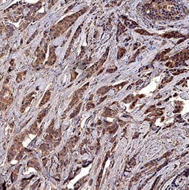 Survivin was detected in immersion fixed paraffin-embedded sections of human breast cancer tissue using Goat Anti-Human Survivin Antigen Affinity-purified Polyclonal Antibody (Catalog # AF6471) at 1 µg/mL for 1 hour at room temperature followed by incubation with the Anti-Goat IgG VisUCyte™ HRP Polymer Antibody (VC004). Tissue was stained using DAB (brown) and counterstained with hematoxylin (blue). Specific staining was localized to cytoplasm and nucleus. View our protocol for IHC Staining with VisUCyte HRP Polymer Detection Reagents.