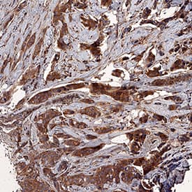 Survivin was detected in immersion fixed paraffin-embedded sections of human breast cancer tissue using Rabbit Anti-Human Survivin Antigen Affinity-purified Polyclonal Antibody (Catalog # AF886) at 3 µg/mL for 1 hour at room temperature followed by incubation with the Anti-Rabbit IgG VisUCyte™ HRP Polymer Antibody (VC003). Tissue was stained using DAB (brown) and counterstained with hematoxylin (blue). Specific staining was localized to cytoplasm. View our protocol for IHC Staining with VisUCyte HRP Polymer Detection Reagents.