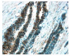 Survivin was detected in immersion fixed paraffin-embedded sections of human prostate cancer tissue using 10 µg/mL Rabbit Anti-Human Survivin Antigen Affinity-purified Polyclonal Antibody (Catalog # AF886) overnight at 4 °C. Before incubation with the primary antibody tissue was subjected to heat-induced epitope retrieval using Antigen Retrieval Reagent-Basic (CTS013). Tissue was stained with the Anti-Rabbit HRP-DAB Cell & Tissue Staining Kit (brown; CTS005) and counterstained with hematoxylin (blue). View our protocol for Chromogenic IHC Staining of Paraffin-embedded Tissue Sections.