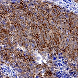 Syndecan-1/CD138 was detected in immersion fixed paraffin-embedded sections of human cervical cancer tissue using Rat Anti-Human Syndecan-1/CD138 Monoclonal Antibody (Catalog # MAB2780) at 1.7 µg/mL overnight at 4 °C. Tissue was stained using the Anti-Rat HRP-DAB Cell & Tissue Staining Kit (brown; Catalog # CTS017) and counterstained with hematoxylin (blue). Specific staining was localized to plasma membrane. View our protocol for Chromogenic IHC Staining of Paraffin-embedded Tissue Sections.