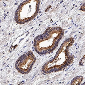 TBK1 was detected in immersion fixed paraffin-embedded sections of human prostate cancer tissue using Sheep Anti-Human TBK1 Antigen Affinity-purified Polyclonal Antibody (Catalog # AF9934) at 3 µg/mL overnight at 4 °C. Tissue was stained using the Anti-Sheep HRP-DAB Cell & Tissue Staining Kit (brown; CTS019) and counterstained with hematoxylin (blue). Specific staining was localized to cytoplasm in epithelial cells. View our protocol for Chromogenic IHC Staining of Paraffin-embedded Tissue Sections.