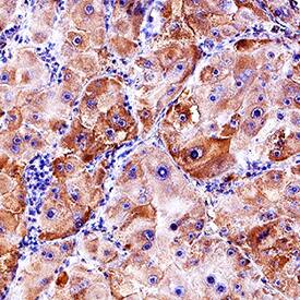 TEM8/ANTXR1 was detected in immersion fixed paraffin-embedded sections of human liver cancer tissue using Goat Anti-Human TEM8/ANTXR1 Isoform 1 Antigen Affinity-purified Polyclonal Antibody (Catalog # AF3886) at 3 µg/mL for 1 hour at room temperature followed by incubation with the Anti-Goat IgG VisUCyte™ HRP Polymer Antibody (Catalog # VC004). Tissue was stained using DAB (brown) and counterstained with hematoxylin (blue). Specific staining was localized to cytoplasm and plasma membrane. View our protocol for IHC Staining with VisUCyte HRP Polymer Detection Reagents.