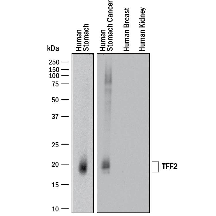Western blot shows lysates of human stomach tissue, human stomach cancer tissue, human breast tissue, and human kidney tissue. PVDF membrane was probed with 2 µg/mL of Goat Anti-Human TFF2 Antigen Affinity-purified Polyclonal Antibody (Catalog # AF4077) followed by HRP-conjugated Anti-Goat IgG Secondary Antibody (Catalog # HAF017). A specific band was detected for TFF2 at approximately 19-21 kDa (as indicated). This experiment was conducted under reducing conditions and using Immunoblot Buffer Group 1.