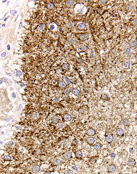 TGF-a was detected in immersion fixed paraffin-embedded sections of human astrocytoma using 15 µg/mL Goat Anti-Human TGF-a Antigen Affinity-purified Polyclonal Antibody (Catalog # AF-239-NA) overnight at 4 °C. Before incubation with the primary antibody tissue was subjected to heat-induced epitope retrieval using Antigen Retrieval Reagent-Basic (Catalog # CTS013). Tissue was stained with the Anti-Goat HRP-DAB Cell & Tissue Staining Kit (brown; Catalog # CTS008) and counterstained with hematoxylin (blue). View our protocol for Chromogenic IHC Staining of Paraffin-embedded Tissue Sections.