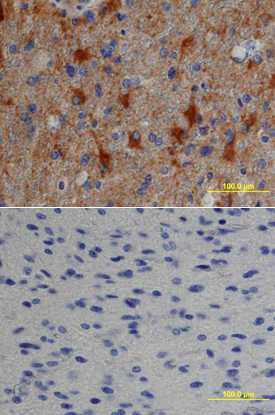 TGF-a was detected in immersion fixed paraffin-embedded sections of human astrocytoma using Goat Anti-Human TGF-a Antigen Affinity-purified Polyclonal Antibody (Catalog # AF-239-NA) at 15 µg/mL overnight at 4 °C. Tissue was stained using the Anti-Goat HRP-DAB Cell & Tissue Staining Kit (brown; Catalog # CTS008) and counterstained with hematoxylin (blue). Lower panel shows a lack of labeling if primary antibodies are omitted and tissue is stained only with secondary antibody followed by incubation with detection reagents. View our protocol for Chromogenic IHC Staining of Paraffin-embedded Tissue Sections.