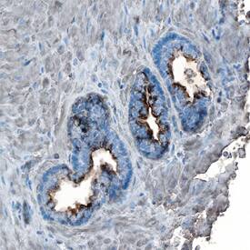 TGF-beta 2 was detected in immersion fixed paraffin-embedded sections of human prostate cancer tissue using Mouse Anti-TGF-beta 2 Monoclonal Antibody (Catalog # MAB612) at 15 µg/mL overnight at 4 °C. Tissue was stained using the Anti-Mouse HRP-DAB Cell & Tissue Staining Kit (brown; Catalog # CTS002) and counterstained with hematoxylin (blue). Specific staining was localized to cytoplasm in cancer cells. View our protocol for Chromogenic IHC Staining of Paraffin-embedded Tissue Sections.